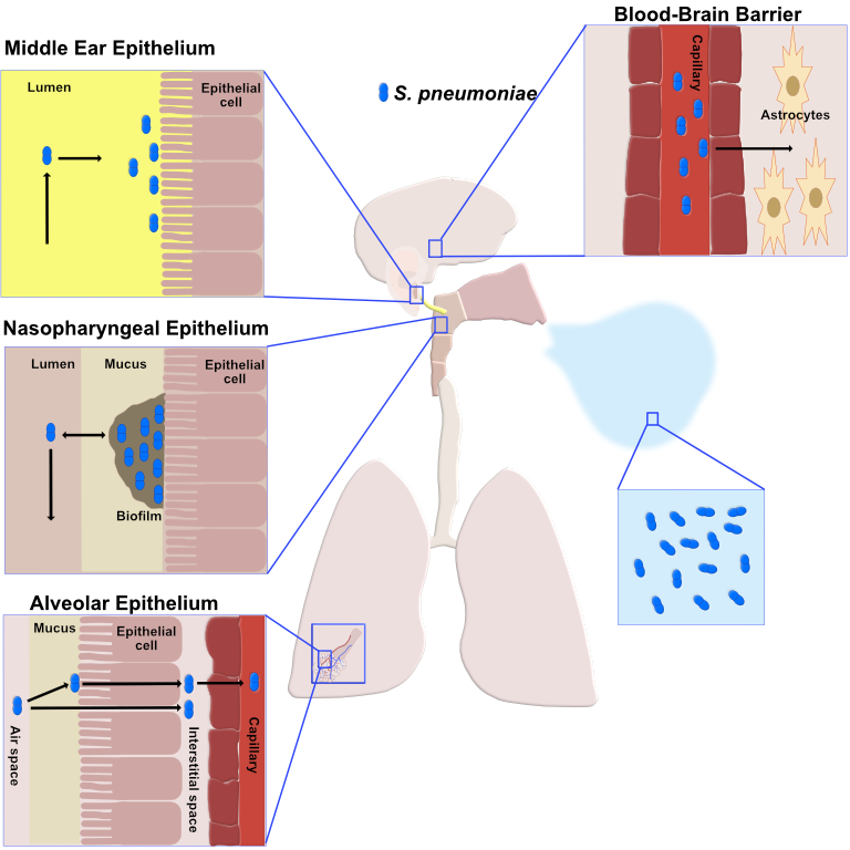 pneumococcal disease